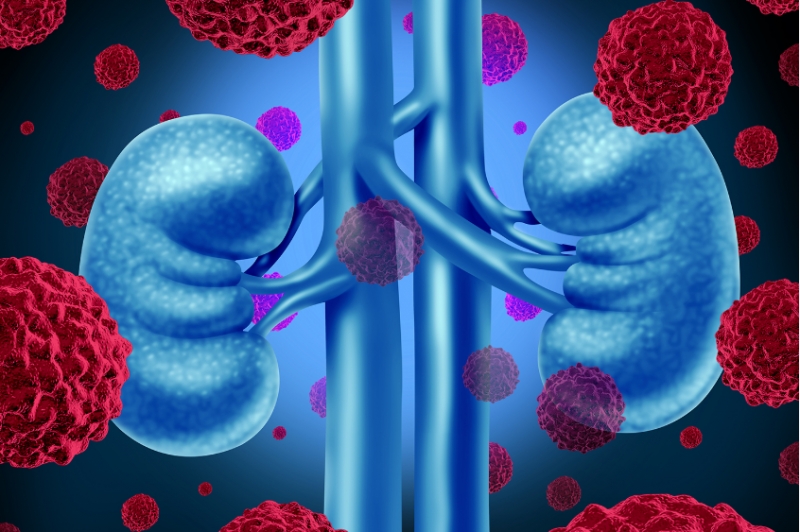 Os avan&ccedil;os no tratamento do c&acirc;ncer renal e a dificuldade de acesso no Brasil