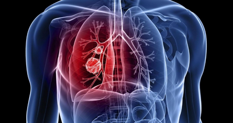 ANVISA aprova Alectinibe para o tratamento de c&acirc;ncer de pulm&atilde;o